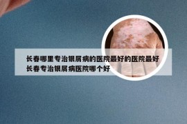 长春哪里专治银屑病的医院最好的医院最好 长春专治银屑病医院哪个好