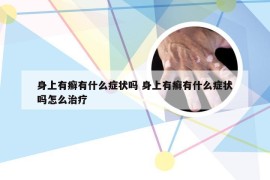 身上有癣有什么症状吗 身上有癣有什么症状吗怎么治疗