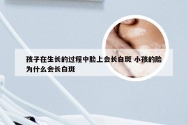 孩子在生长的过程中脸上会长白斑 小孩的脸为什么会长白斑