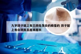 九岁孩子腿上有三四处发白的癣是的 孩子腿上有白斑而且越来越长