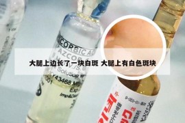 大腿上边长了一块白斑 大腿上有白色斑块