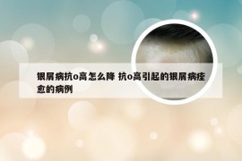 银屑病抗o高怎么降 抗o高引起的银屑病痊愈的病例