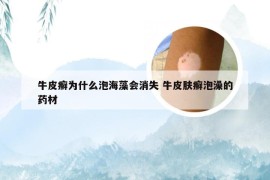 牛皮癣为什么泡海藻会消失 牛皮肤癣泡澡的药材