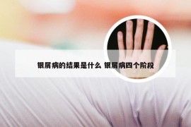 银屑病的结果是什么 银屑病四个阶段