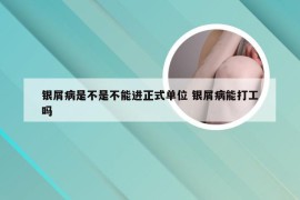 银屑病是不是不能进正式单位 银屑病能打工吗