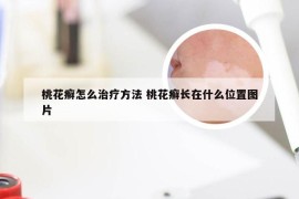 桃花癣怎么治疗方法 桃花癣长在什么位置图片