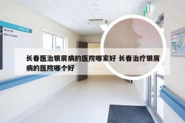 长春医治银屑病的医院哪家好 长春治疗银屑病的医院哪个好