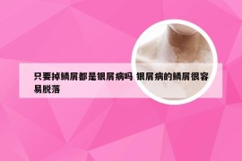 只要掉鳞屑都是银屑病吗 银屑病的鳞屑很容易脱落