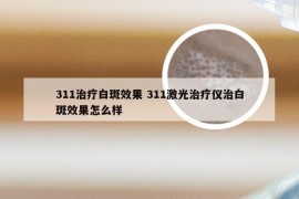 311治疗白斑效果 311激光治疗仪治白斑效果怎么样