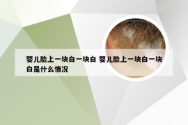 婴儿脸上一块白一块白 婴儿脸上一块白一块白是什么情况