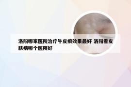 洛阳哪家医院治疗牛皮癣效果最好 洛阳看皮肤病哪个医院好