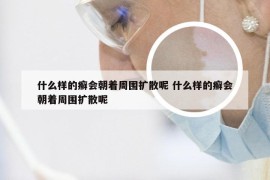 什么样的癣会朝着周围扩散呢 什么样的癣会朝着周围扩散呢