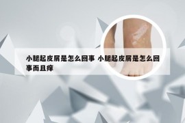 小腿起皮屑是怎么回事 小腿起皮屑是怎么回事而且痒