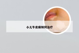 小儿牛皮癣如何治疗