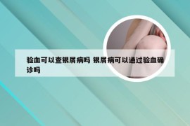 验血可以查银屑病吗 银屑病可以通过验血确诊吗