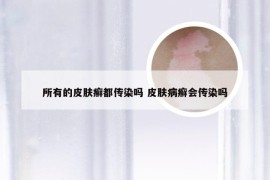 所有的皮肤癣都传染吗 皮肤病癣会传染吗