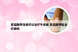 高锰酸钾泡澡可以治疗牛皮癣 高锰酸钾能治疗癣吗