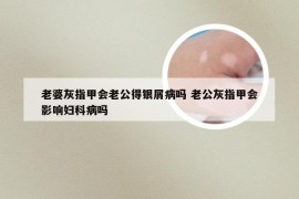 老婆灰指甲会老公得银屑病吗 老公灰指甲会影响妇科病吗