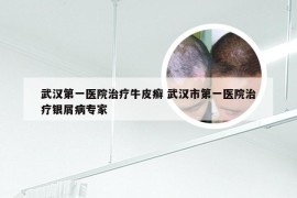 武汉第一医院治疗牛皮癣 武汉市第一医院治疗银屑病专家