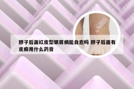 脖子后面红皮型银屑病能自愈吗 脖子后面有皮癣用什么药膏