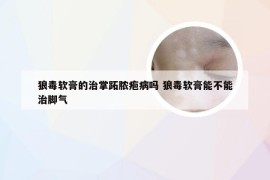 狼毒软膏的治掌跖脓疱病吗 狼毒软膏能不能治脚气