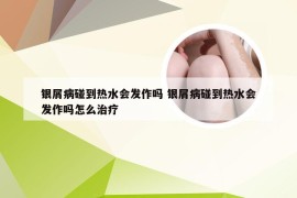 银屑病碰到热水会发作吗 银屑病碰到热水会发作吗怎么治疗