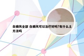 白癞风全部 白癞风可以治疗好吗?有什么土方法吗