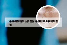 牛皮癣生物剂价格医保 牛皮肤癣生物制剂医保