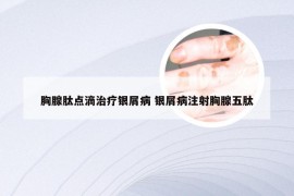 胸腺肽点滴治疗银屑病 银屑病注射胸腺五肽