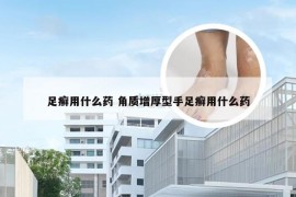 足癣用什么药 角质增厚型手足癣用什么药