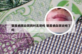 银屑病跟白斑同时出现吗 银屑病白斑说明了吗