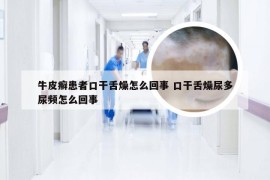 牛皮癣患者口干舌燥怎么回事 口干舌燥尿多尿频怎么回事