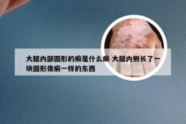 大腿内部圆形的癣是什么癣 大腿内侧长了一块圆形像癣一样的东西