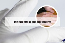 刺血拔罐银屑病 银屑病用拔罐放血