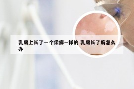 乳房上长了一个像癣一样的 乳房长了癣怎么办