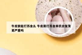 牛皮肤能打苏金么 牛皮屑打苏金单抗会复发更严重吗