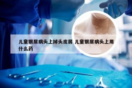 儿童银屑病头上掉头皮屑 儿童银屑病头上用什么药