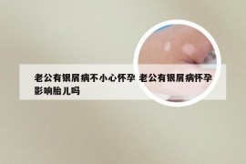 老公有银屑病不小心怀孕 老公有银屑病怀孕影响胎儿吗