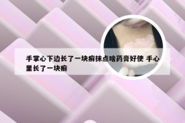 手掌心下边长了一块癣抹点啥药膏好使 手心里长了一块癣