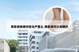 银屑病用碘伏擦会严重么 银屑病可以用碘伏