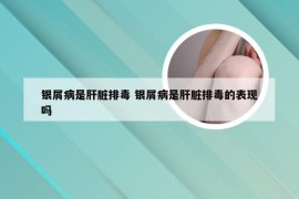 银屑病是肝脏排毒 银屑病是肝脏排毒的表现吗