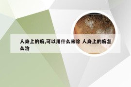 人身上的癣,可以用什么来除 人身上的癣怎么治