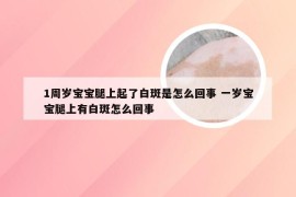 1周岁宝宝腿上起了白斑是怎么回事 一岁宝宝腿上有白斑怎么回事