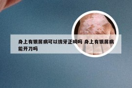 身上有银屑病可以拔牙正畸吗 身上有银屑病能开刀吗