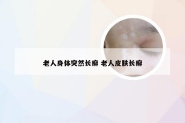 老人身体突然长癣 老人皮肤长癣