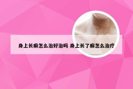 身上长癣怎么治好治吗 身上长了癣怎么治疗