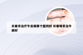 长春市治疗牛皮癣那个医院好 长春哪家治牛癣好