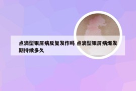 点滴型银屑病反复发作吗 点滴型银屑病爆发期持续多久