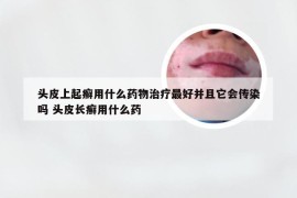 头皮上起癣用什么药物治疗最好并且它会传染吗 头皮长癣用什么药