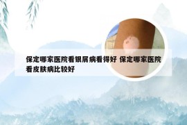 保定哪家医院看银屑病看得好 保定哪家医院看皮肤病比较好